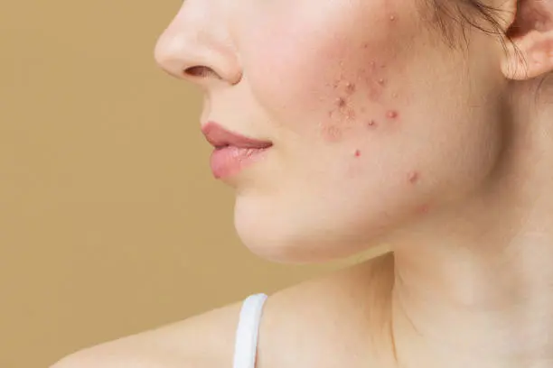 Acne & Blemish Control: Clear Skin Starts Here with K-Beauty Solutions Bonajour Acne & Blemish Control products for clear skin and blemish-free complexion