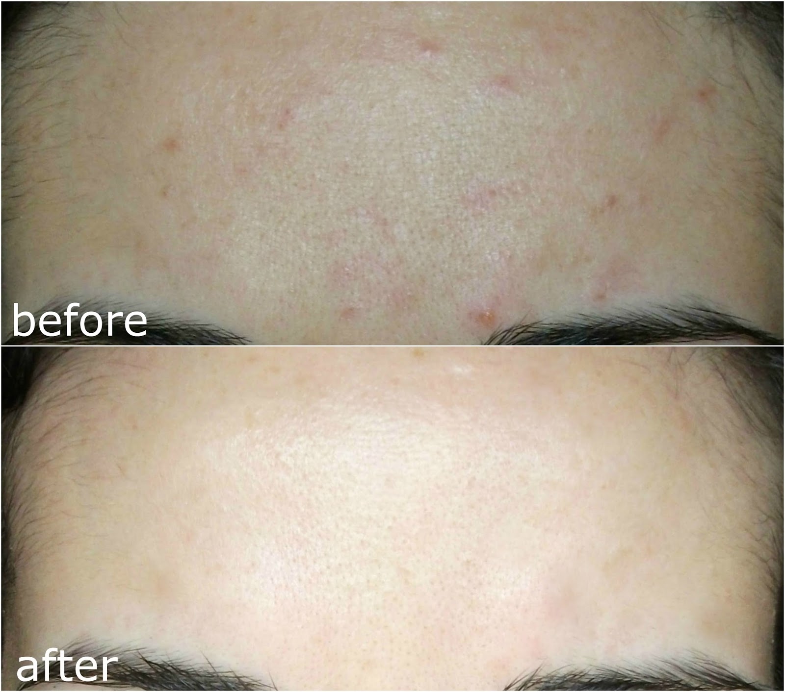 COSRX Advanced Snail 92 All-in-One Cream 100ml used for 12 weeks in day routine with Rx JNN EGF Peptide Serum and at night with Advanced Ex Eye Cream. Purchased from MercelBay in USA.