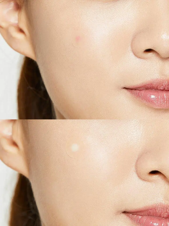 Clear acne fast with COSRX Acne Pimple Master Patch 24 pcs. Fragrance-free, oil-absorbing, skin-protecting patches. Shop better deals at MercelBay vs Ulta, Walmart, Kohl’s.