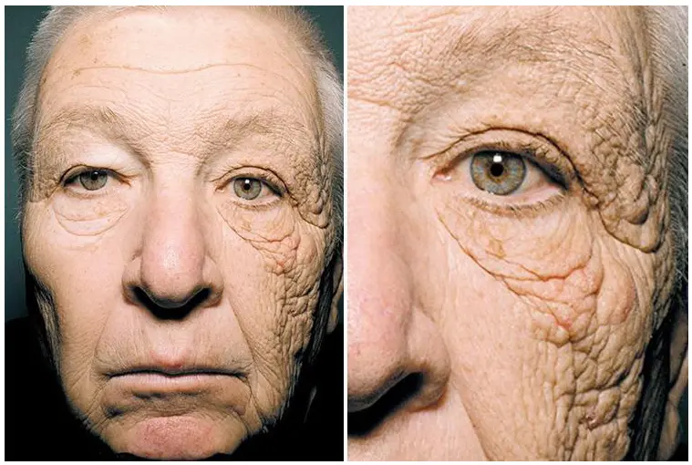Side-by-side comparison of premature aging on skin due to daily sun exposure, showing wrinkles and UV damage on one side of the face