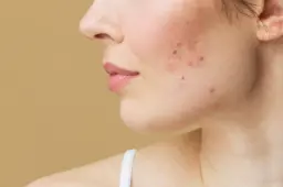 Acne & Blemish Control: Clear Skin Starts Here with K-Beauty Solutions Bonajour Acne & Blemish Control products for clear skin and blemish-free complexion